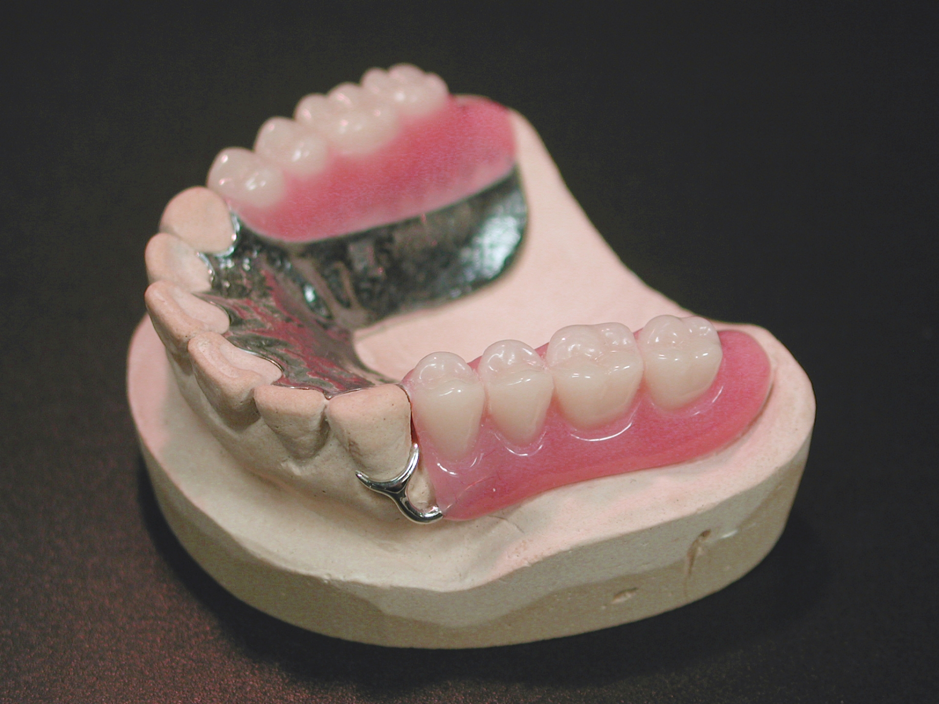 金属 床 による 総 義歯 の 提供